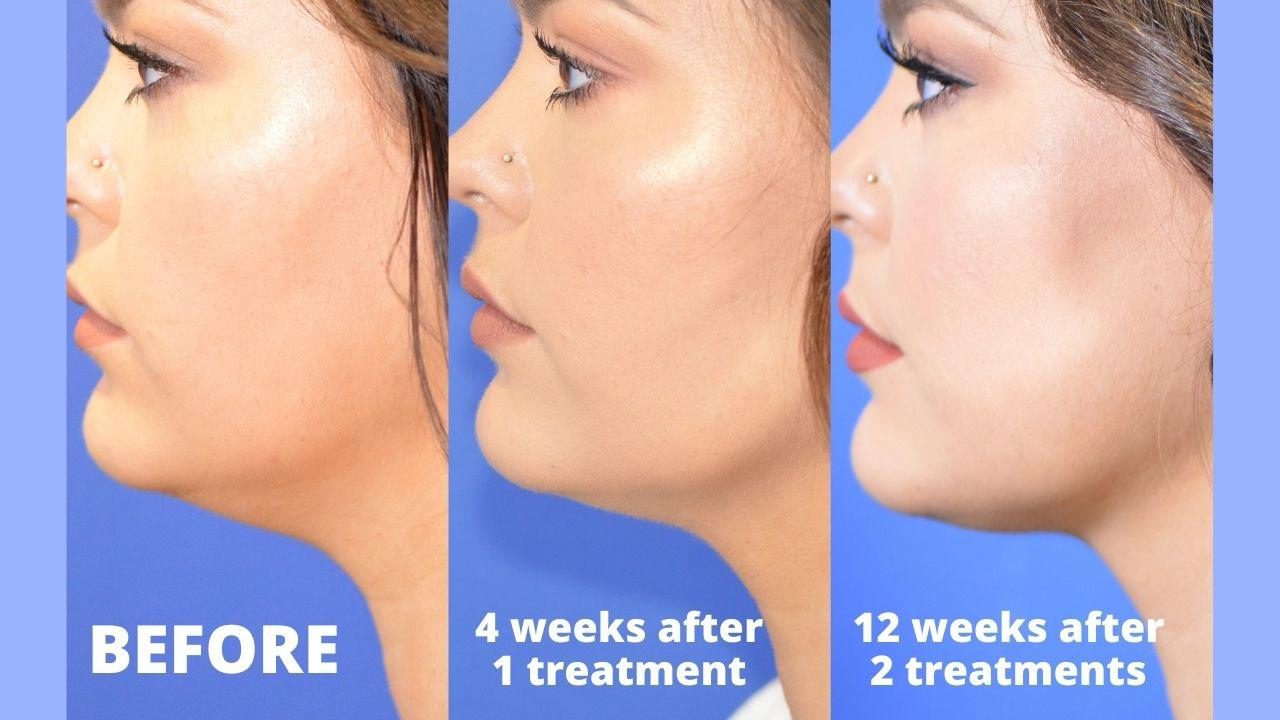 Chin Cool Sculpting